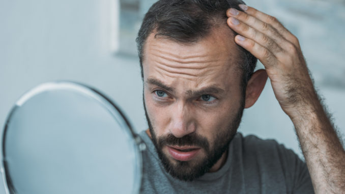 upset middle aged man with alopecia looking at mirror hair loss concept